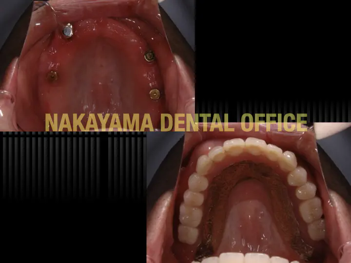 マグネット（磁石）維持装置付き義歯