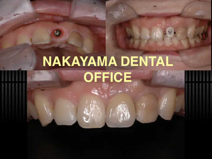 インプラント症例写真