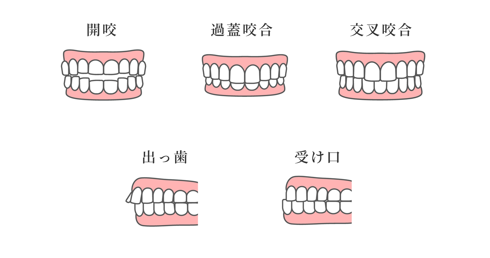 歯並びの種類一覧