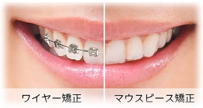 ワイヤー矯正とマウスピース矯正の比較